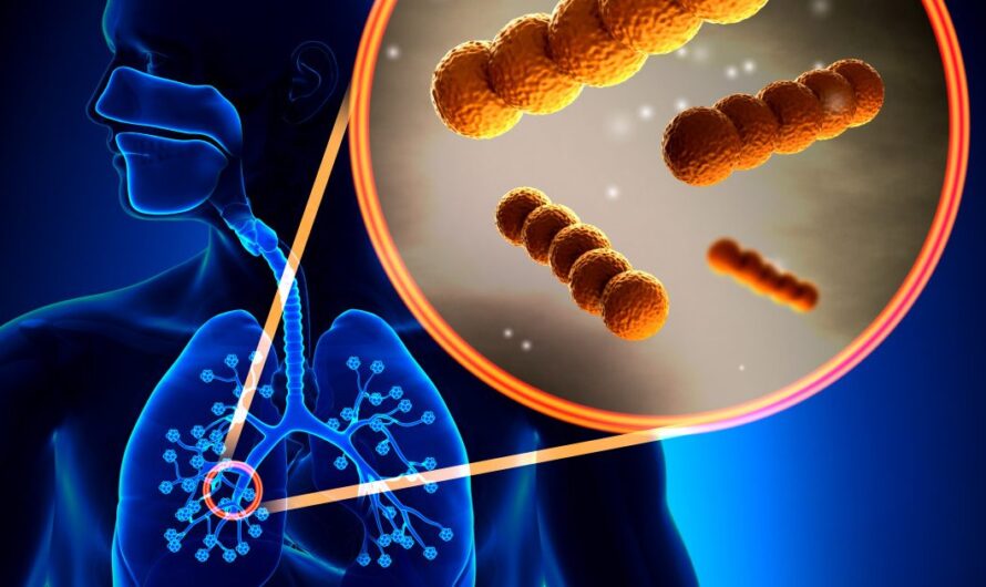 Bronchiectasis Drugs Market Growing Awareness and Advancements in Treatment Options Driving Market Growth