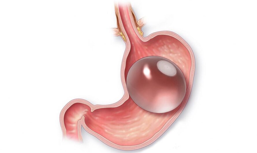The Fast-Growing Intragastric Balloon Market Poised for Significant Value Creation