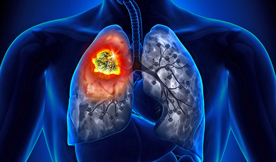 Lung Cancer Surgery Market Is Estimated To Witness High Growth Owing To Rising Lung Cancer Prevalence