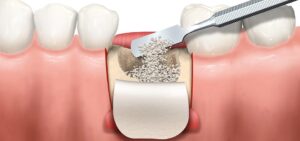 Dental Membrane And Bone Graft Substitute Market
