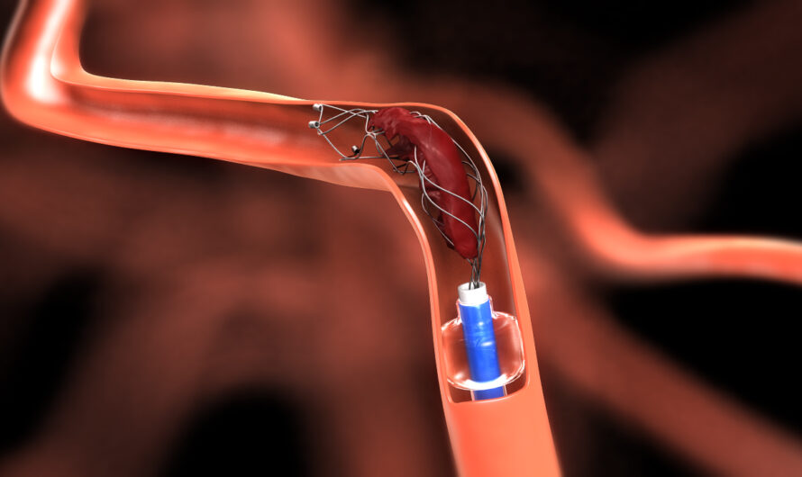 The Growing Popularity Of Minimally Invasive Procedures Is Anticipated To Open Up The New Avenue For Embolization Market