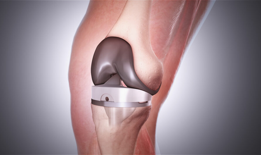 Rising Prevalence Of Knee Osteoarthritis To Fuel Growth In The Total Knee Arthroplasty Market