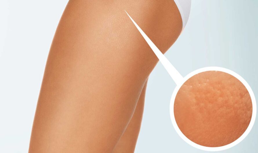 The Growing Demand For Nonsurgical Cellulite Treatments Is Driving The Cellulite Treatment Market