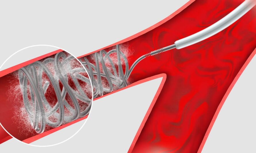 Embolization Market Is Expected To Be Flourished By Growing Adoption Of Minimally Invasive Procedures