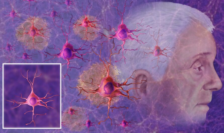 Exhausted Immune Cells Could Contribute to Alzheimer’s Disease, Study Finds