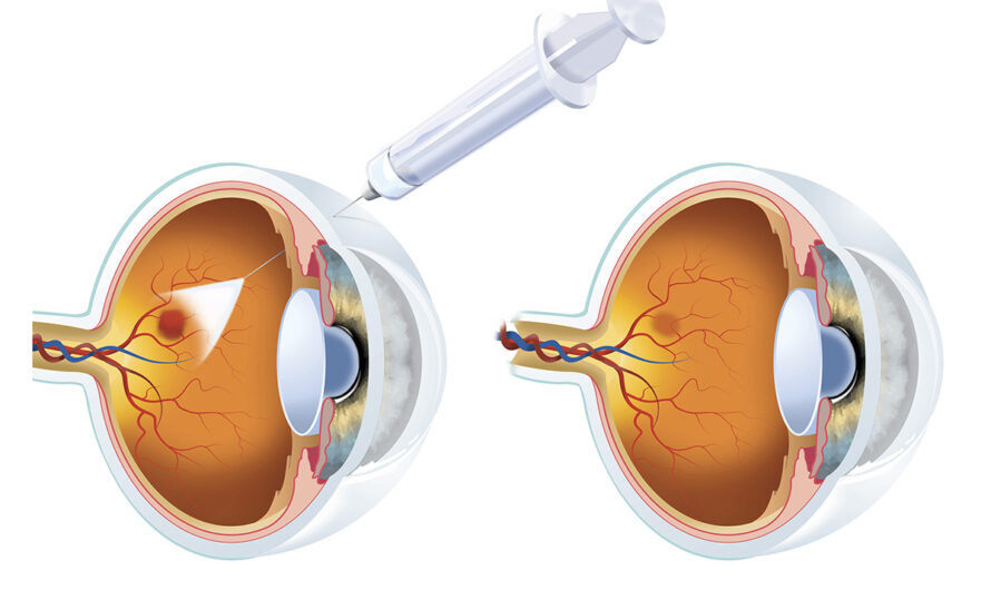 The Global EYLEA Drug Market Processed Is Fuelled By Growing Retinal Disorders Prevalence
