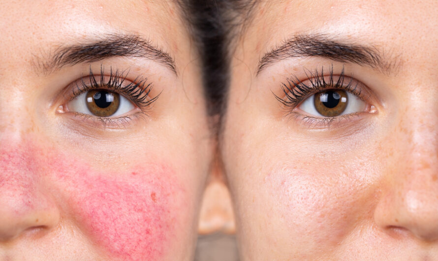 Rosacea Treatment Market is Expected to be Flourished by Rising Prevalence of Rosacea Disease