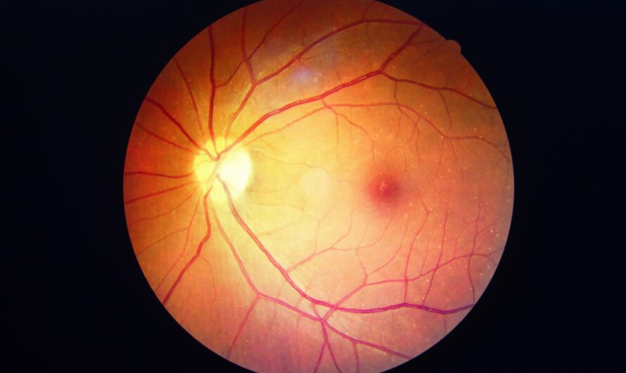 Diabetic Retinopathy: A Leading Cause Of Vision Loss