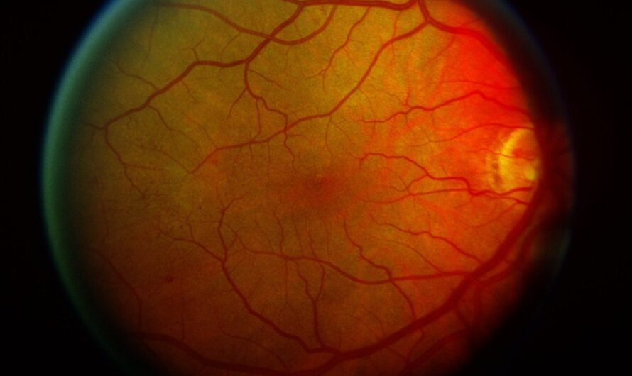 The Rising Prevalence Of Diabetes Is Driving Growth Of The Diabetic Retinopathy Market