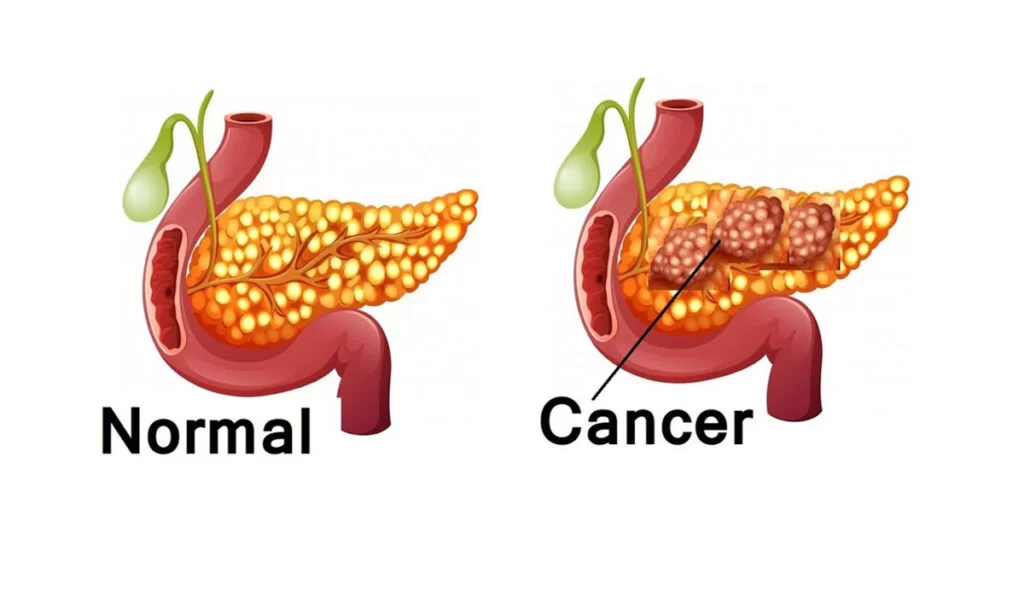 Pancreatic Cancer Therapeutics and Diagnostics