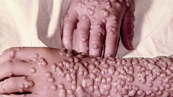 Global Smallpox Treatment Is Evolving On The Trends Of Growing Epidemic Outbreaks