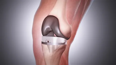 Total Knee Arthroplasty Unveiled: A Deep Dive into Surgical Procedures, Rehabilitation, and Patient Outcomes