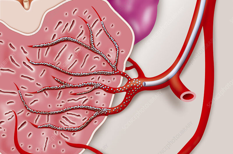 Prostatic Artery Embolization: A Safe and Effective Treatment for Benign Prostatic Hyperplasia