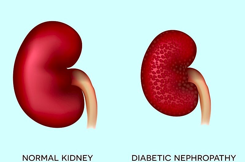 Diabetic Kidney Disease: Understanding the Leading Cause of Kidney Failure