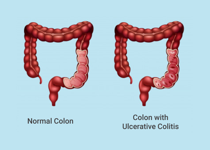 The United Kingdom Ulcerative Colitis Market is Estimated to Witness High Growth Owing to Surging Prevalence of Inflammatory Bowel Disease