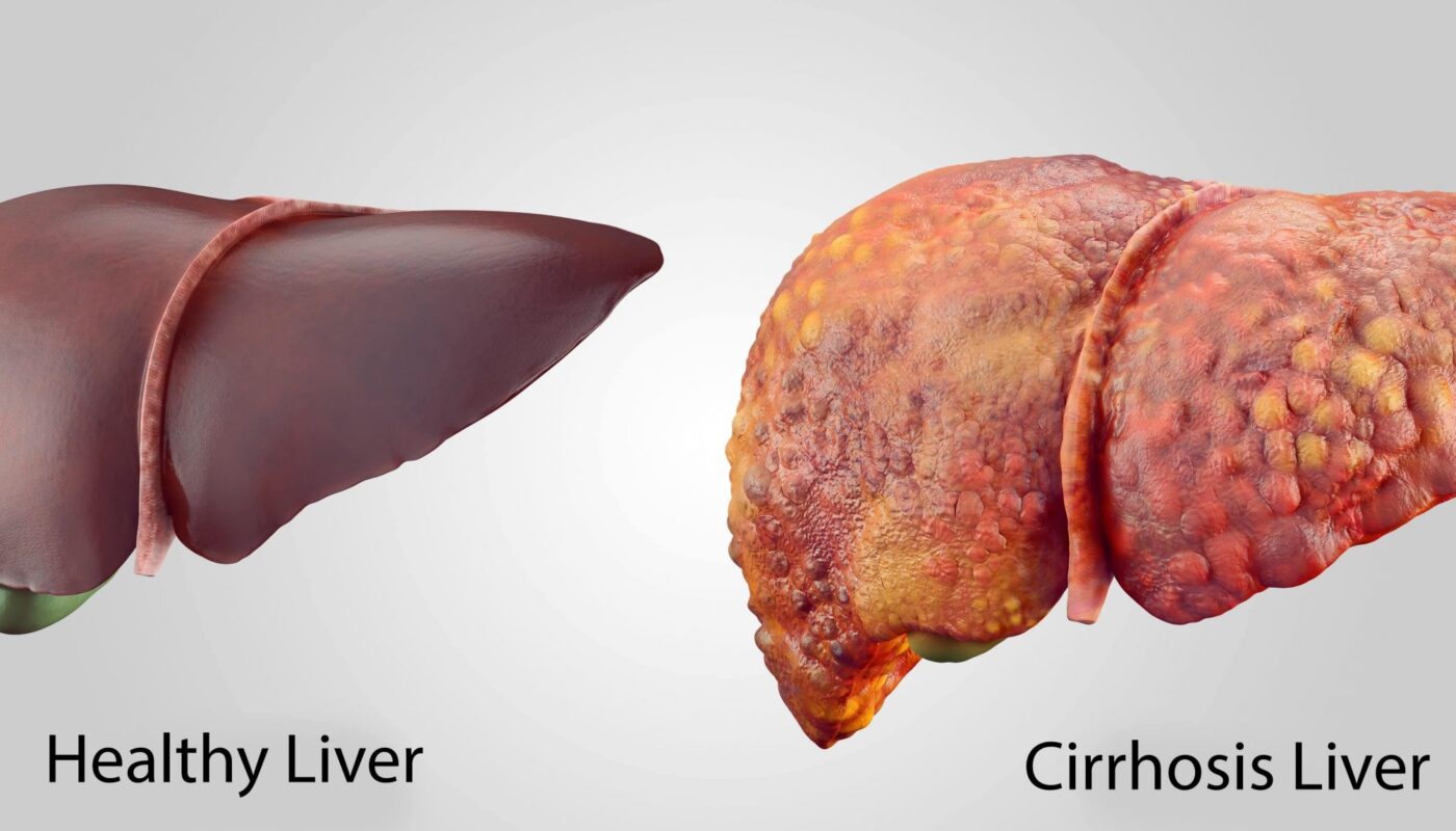 University of Oklahoma Researchers Uncover Complex Interplay Between Liver Fat and Insulin Sensitivity: MLN4924's Role in Preventing Fatty Liver Disease