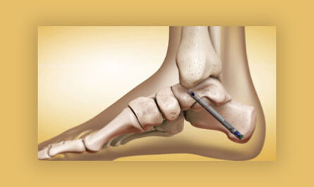 Global Ankle Fusion Nail