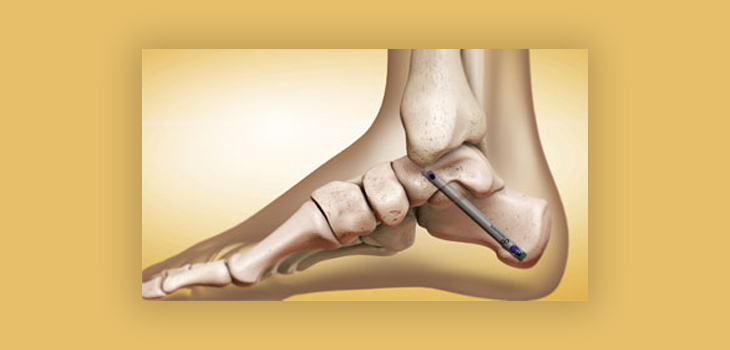Ankle Fusion Nail Industry: An Innovative Treatment Option for Ankle Arthritis Market