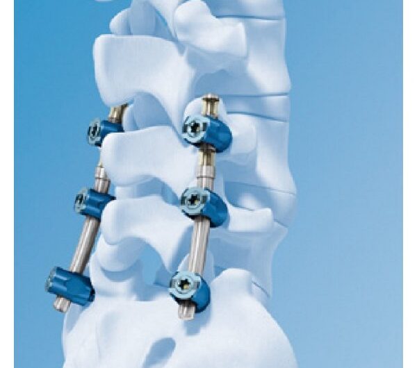 Innovations Shaping the Future of Spine Surgery A New Era of Minimally Invasive Procedures and Advanced Technologies