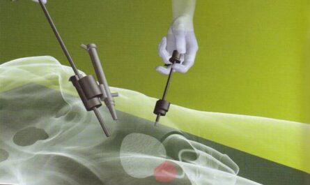 Global Laparoscopic Electrodes